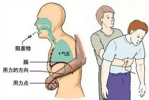 急救手册:窒息